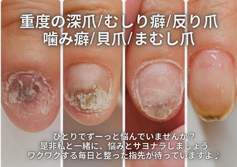 神戸深爪矯正ネイルサロン アリエ